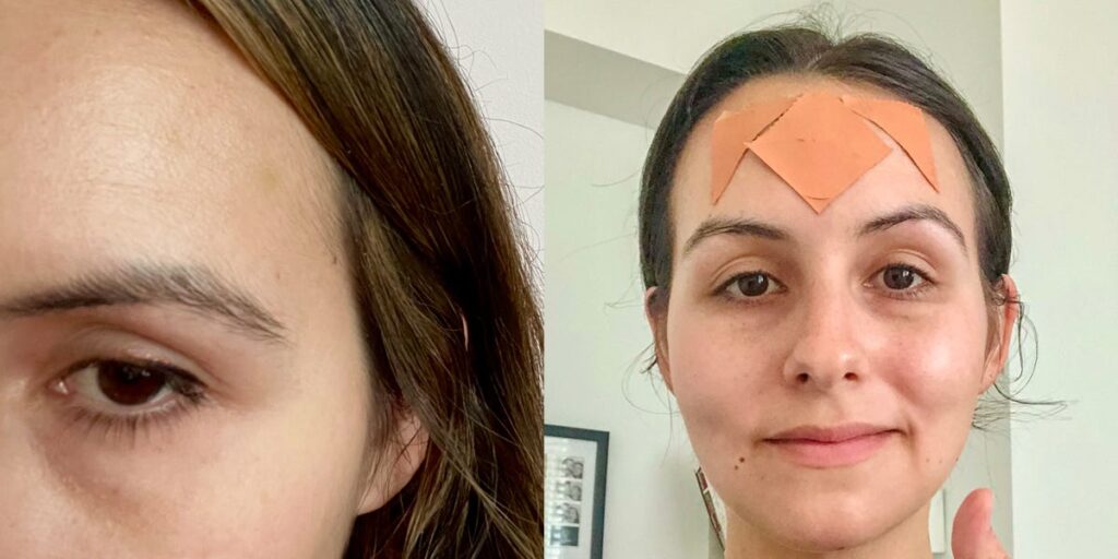 I tried both Botox and face tape for my forehead lines. Neither is perfect, but one feels better in the long run.