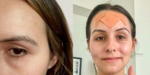 I tried both Botox and face tape for my forehead lines. Neither is perfect, but one feels better in the long run.